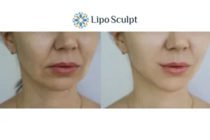Explaining Total Skin Tightening Treatment And What It Can Do For You 2 Do you want to boost your self confidence? Give Morpheus8 Bognor Regis a try today!