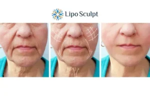 Explaining Total Skin Tightening Treatment And What It Can Do For You 3 Boost your confidence with Morpheus8 Bognor Regis call our team today!