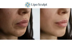 Explaining Total Skin Tightening Treatment And What It Can Do For You 4 Morpheus8 Bognor Regis the best results - call our team today!