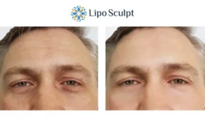 Explaining Total Skin Tightening Treatment And What It Can Do For You 6 Morpheus8 Bognor Regis book in today to find out more!