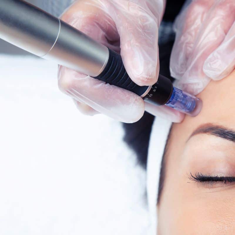 Morpheus8 treatment Bognor Regis from Lipo Sculpt - Book in today!